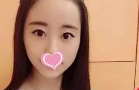 我在大同美神整形做的韩式三点7mm双眼皮价格挺实惠,来看看恢复效果好不好