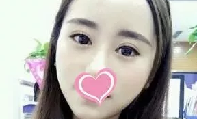 我在大同美神整形做的韩式三点7mm双眼皮价格挺实惠,来看看恢复效果好不好 图2
