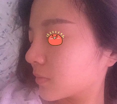 当我把想去金华亚美找邓泽臣做鼻综合隆鼻的想法告诉男友后,他居然同意了还主动掏钱
