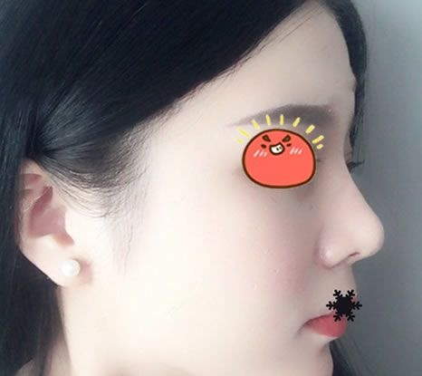 当我把想去金华亚美找邓泽臣做鼻综合隆鼻的想法告诉男友后,他居然同意了还主动掏钱 图2