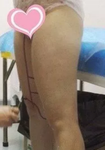 之前在廊坊华康做腰腹吸脂效果超棒 后来又找刘文阁做完大腿吸脂轻松摆脱大象腿
