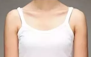 来见证我在运城华美整形做的自体脂肪隆胸一个月消肿后效果如何 看这钱花的值不值
