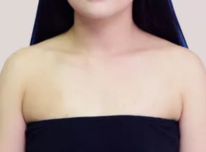 一个月前我找运城丽都整形王新灿做了自体脂肪隆胸来看消肿后的效果如何