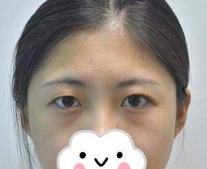 湖南双眼皮哪家好?分享我在岳阳你美美容医院做双眼皮+开眼角20天的前后对比过程,不得不说徐斌院长的技术真的是无可挑剔