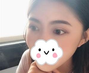 湖南双眼皮哪家好?分享我在岳阳你美美容医院做双眼皮+开眼角20天的前后对比过程,不得不说徐斌院长的技术真的是无可挑剔 图2