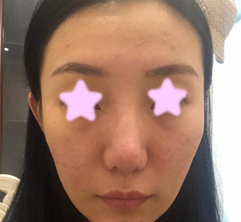 晒晒我在大同清木整形做全脸自体脂肪填充的前后效果图,老妈说我做的价格不贵