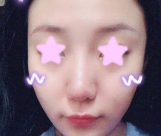 晒晒我在大同清木整形做全脸自体脂肪填充的前后效果图，老妈说我做的价格不贵 案例图2