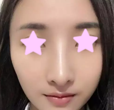 今天给大家说说我一个月前在大同清木整形做自体肋骨隆鼻个人经历 案例图2