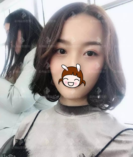 内双无神单眼皮的泰州丽都小护士找院长王勇做了翘睫灵动大眼术后开启睛彩之旅 图2