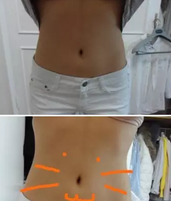 大同清木整形怎么样?爆料我做腰腹部360水动力吸脂真实经历及20天恢复效果图 图2