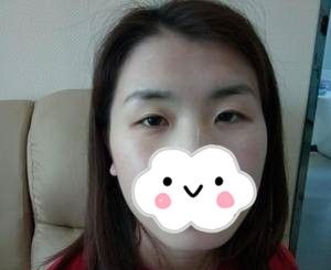 株洲希美全切双眼皮真人案例,一个月恢复全过程记录