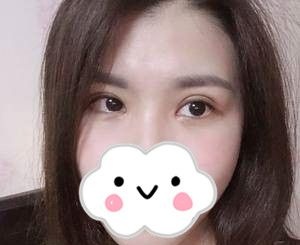 株洲希美全切双眼皮真人案例,一个月恢复全过程记录 图2