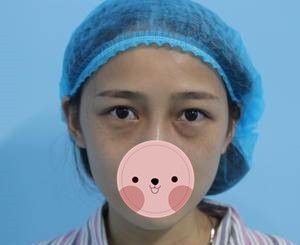 株洲宇芳姬整形李鹤医生内切祛眼袋真人案例,手术15天恢复过程记录