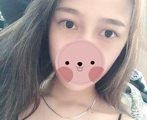 株洲宇芳姬整形李鹤医生内切祛眼袋真人案例,手术15天恢复过程记录 图2