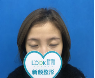瞧我花1万多元找珠海新颜整形医院乐美芳医生做的全切双眼皮效果好看吗