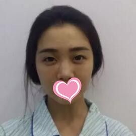 永州博美整形医院怎么样?看我找陈兵做的假体隆鼻术后三个月恢复效果!