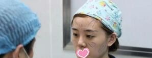 真人案例:永州博美整形美容医院自体脂肪填充面部恢复全过程前后对比照片分享