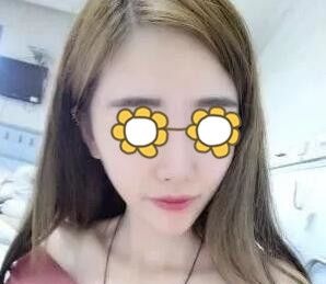真人案例:永州博美整形美容医院自体脂肪填充面部恢复全过程前后对比照片分享 图2