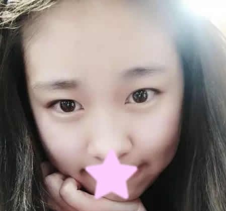 本人花800元做埋线双眼皮失败后，才到正规的运城丽都做全切双眼皮整形失败修复