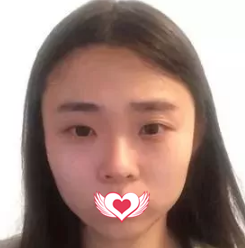 邯郸京美张伟做眼鼻综合整形效果很厉害 1个月时间让我的无神小眼和扁平塌鼻变成如今的媚眼翘鼻