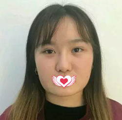 看完邯郸京美吸脂价格表后决定找王培院长做面部吸脂摆脱26年的大饼脸