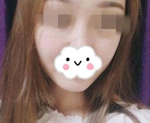 我在湖南做面部吸脂,术后不到一个月惊喜的拥有了V字脸 图2