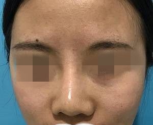 我在湘潭雅美医疗美容医院做的嫩肤术后20天后的效果
