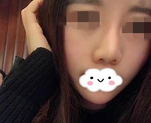 我在湘潭雅美医疗美容医院做的嫩肤术后20天后的效果 图2