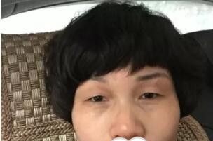 上眼皮松驰的我去郴州唯美咨询并直接做了切开双眼皮后老公说我年轻10岁!