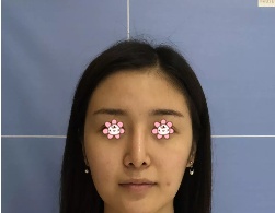 宁夏华美整形美容医院何林这个面部线雕提升做得让我有了个美美的苹果肌！