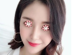 宁夏华美整形美容医院何林这个面部线雕提升做得让我有了个美美的苹果肌! 图2