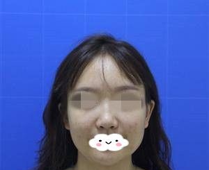 在湘潭雅美医疗美容医院做完鼻修复20天后的我就迫不及待的发照片给闺蜜，闺蜜们都说简直太好看了