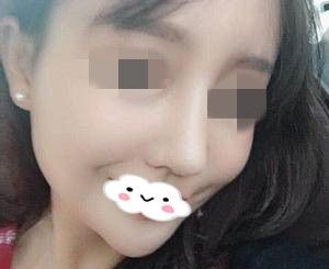在湘潭雅美医疗美容医院做完鼻修复20天后的我就迫不及待的发照片给闺蜜,闺蜜们都说简直太好看了 图2