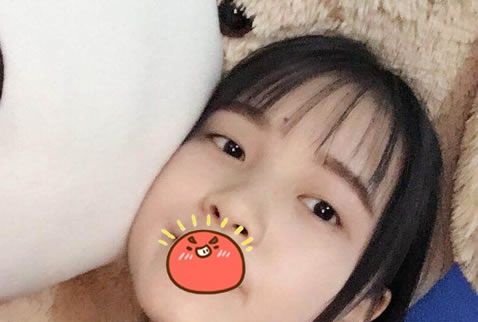 相信看了我在金华瑞丽找刘政院长做双眼皮和开眼角的恢复效果,你也会想割双眼皮的