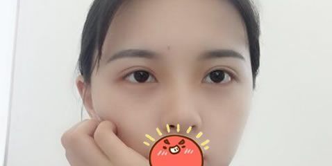 相信看了我在金华瑞丽找刘政院长做双眼皮和开眼角的恢复效果,你也会想割双眼皮的 案例图2