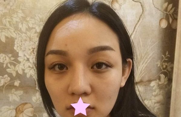 看完包头华美隆鼻+全脸脂肪填充效果案例后 评价一下白虎医生的整形技术怎么样
