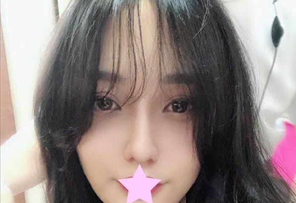 看完包头华美隆鼻+全脸脂肪填充效果案例后 评价一下白虎医生的整形技术怎么样 图2