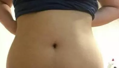 现在腰腹吸脂60天了 想给大家看一下拥有水桶腰的我在邢台博爱做水动力吸脂的真实经历