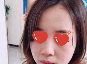 在郴州唯美整形医院做了鼻综合+假体垫下巴后我妈说她都快认不出我了!