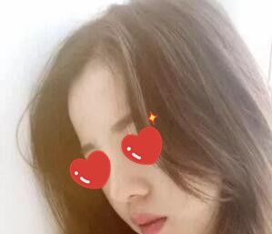 在郴州唯美整形医院做了鼻综合+假体垫下巴后我妈说她都快认不出我了! 图2