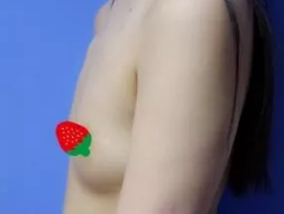 给大家看看我在唐山苏亚美联臣做255CC曼托假体隆胸1个月后的恢复效果