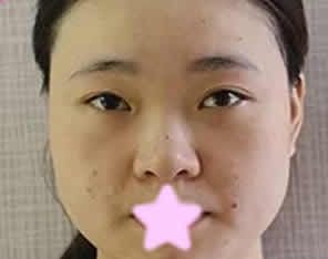 看了我在大同美神整形打瘦脸前后对比照片,大家感觉这效果怎么样