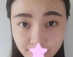 看了我在大同美神整形打瘦脸前后对比照片,大家感觉这效果怎么样 图2