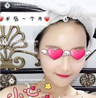 真人案例:分享我在三亚维多利亚整形医院做自体脂肪面部填充日记 图2