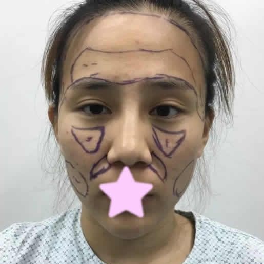 终于在运城丽都整形做了全脸自体脂肪填充 大家来看我第5天恢复照片