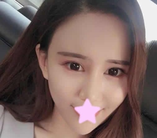 终于在运城丽都整形做了全脸自体脂肪填充 大家来看我第5天恢复照片 图2