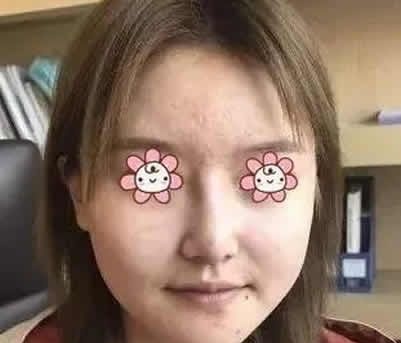 看了一周前在运城华美整形做的面部线雕提升前后对比照片 大家觉得这效果怎么样