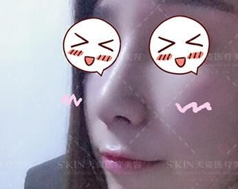 怀化天姿整形美容医院隆鼻怎么样?看我做的鼻综合术后85天恢复效果就知道了! 图2