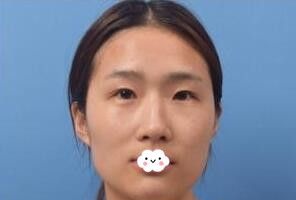 假期我到随州奥莱医疗美容张志田处做双眼皮+开眼角整形了
