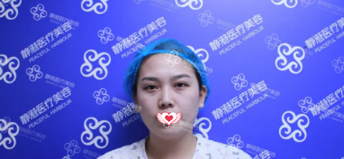 面部苍老的我找沧州静港季泽东院长做自体脂肪填充后瞬变妙龄少女